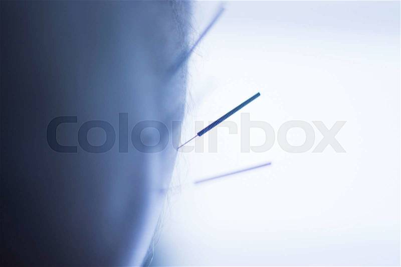 Dry needling acupunture needles used by acupunturist physiotherapist on patient in pain and injury treatment closeup macro hoto, stock photo