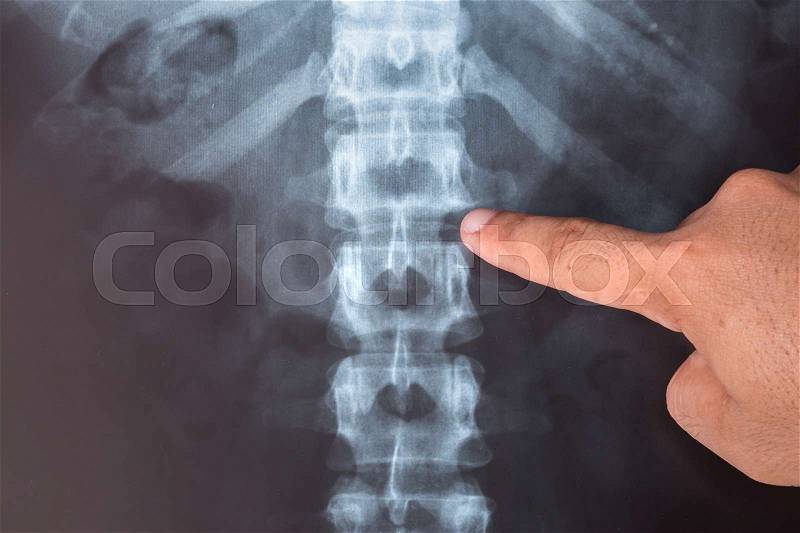 Close up X-Ray image of human for a medical diagnosis, stock photo