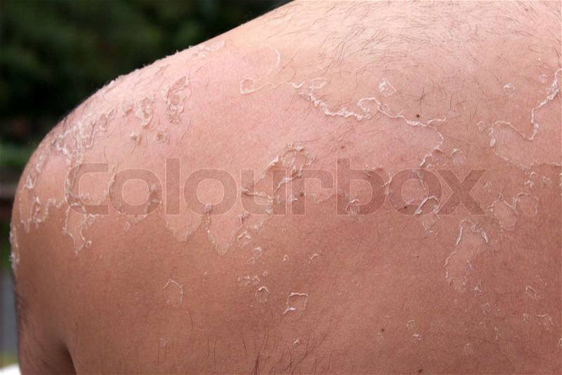 Close up detail of a very bad sunburn showing the peeling blistered skin of a mans backShallow depth of field, stock photo