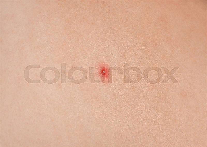 Big red pustules on the skin close-up. Beauty and skin care, stock photo