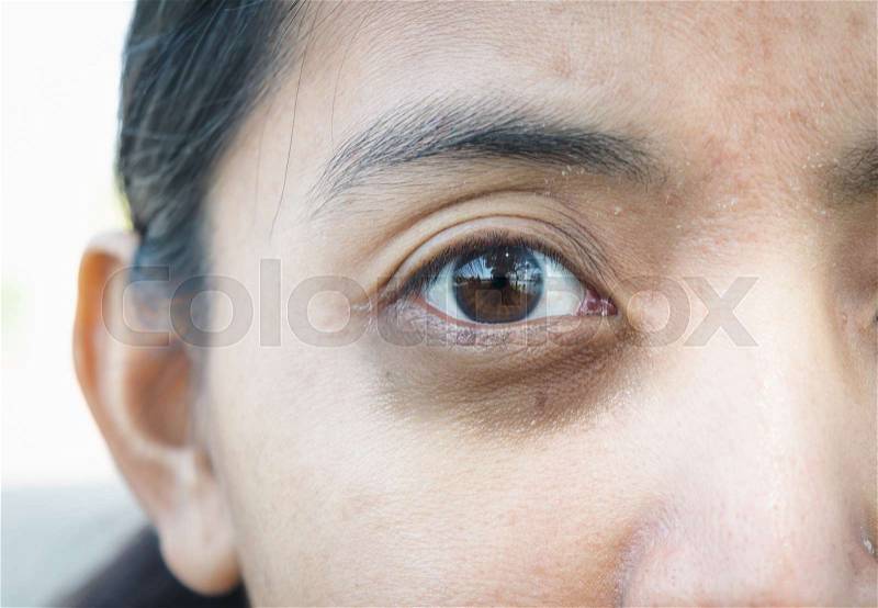 Dark circles around eye, stock photo