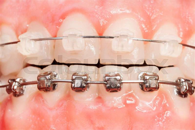 Close-up picture of tooth alignments with ceramic and metal braces, stock photo