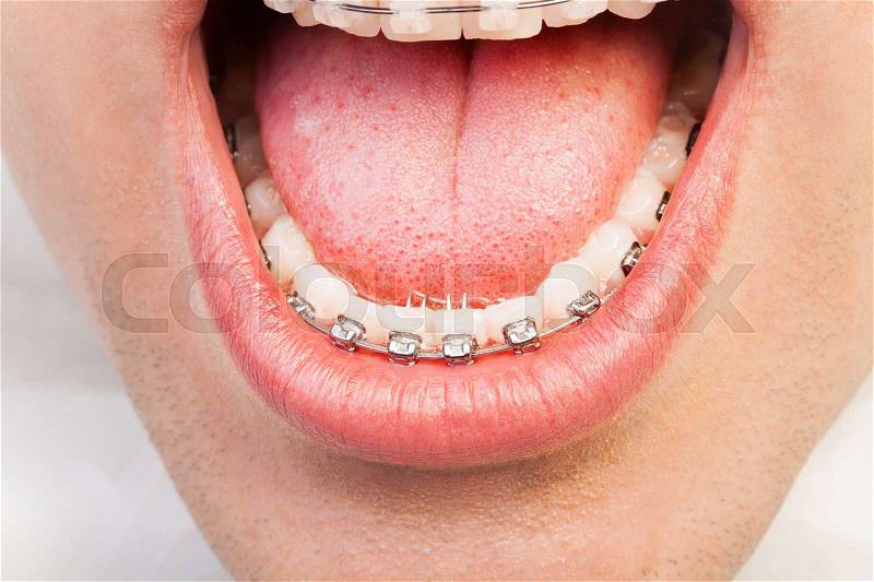 Close-up picture of man\'s wide opened mouth with orthodontic braces, stock photo