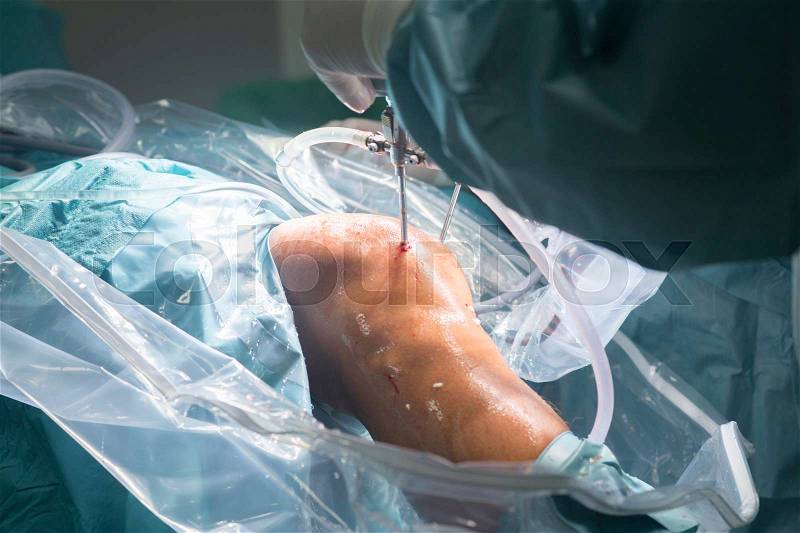Knee keyhole surgery hospital arthroscopy operation medical procedure in emergency room operating theater, stock photo