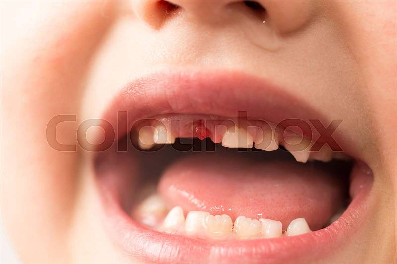 The mouth of a boy without a tooth , stock photo