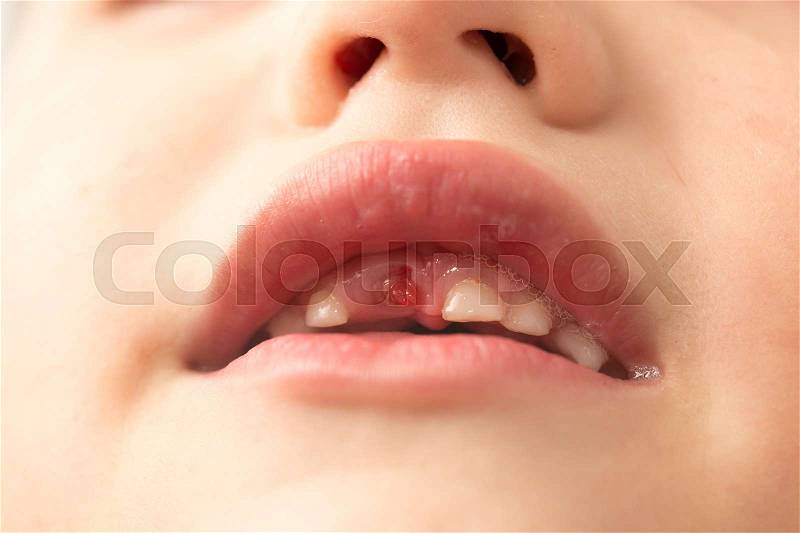 The mouth of a boy without a tooth , stock photo