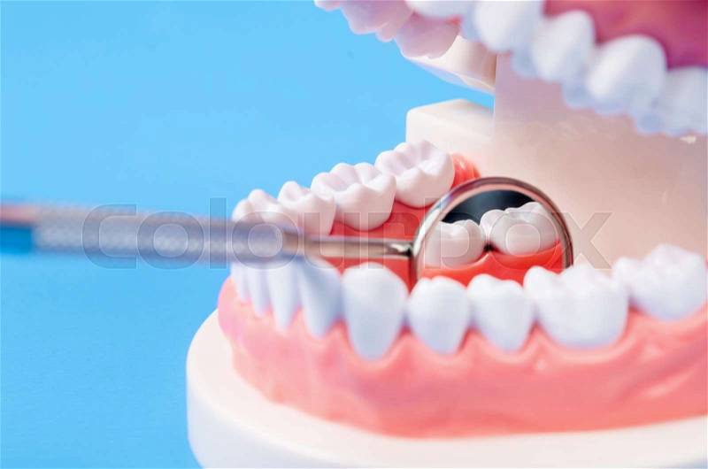 Tooth dental caries on denture with equipment dental on blue background, stock photo