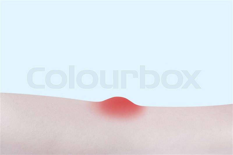 Itchy red spot bump on the skin, stock photo
