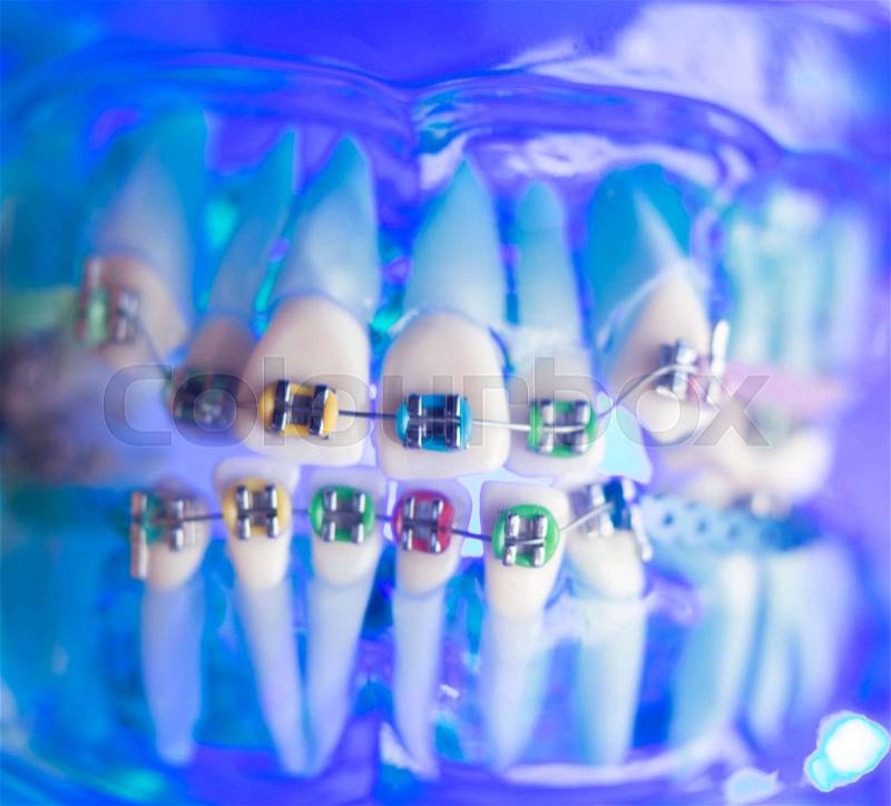 Dental teeth retainers metal aligners brackets to straighten teeth in orthodontic dentistry treatments, stock photo
