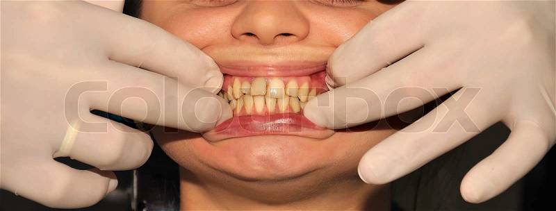 Dontist gloved hands holding the patient\'s lips, stock photo