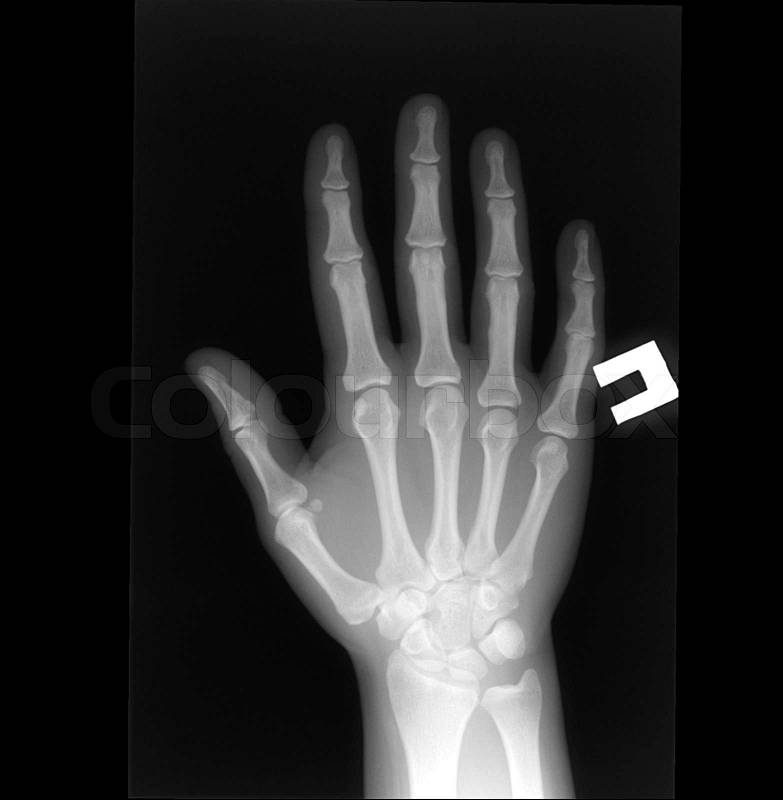 X-ray negative image of human hand, stock photo