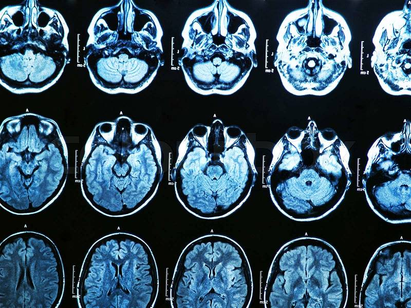 MRI Brain Scan, stock photo