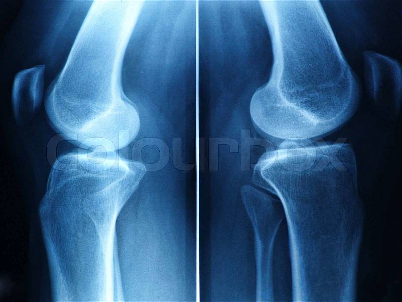 Knee x-ray, stock photo