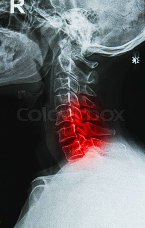 Cervical spine neck x-ray image, stock photo