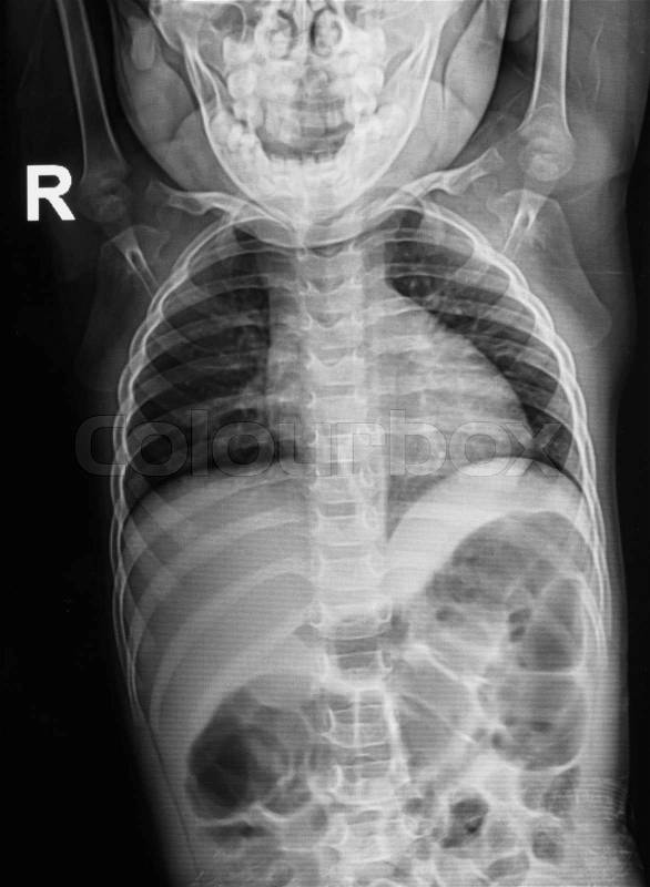 Children chest X-rays, stock photo