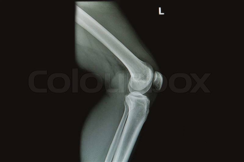 Knee joint x-rays image, stock photo