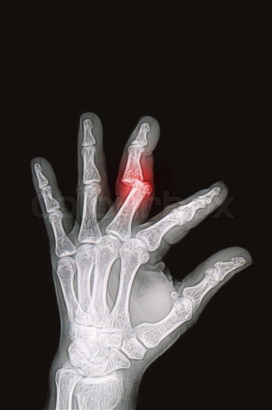Wrist and handx-rays image show fracture and dislocation bone, stock photo