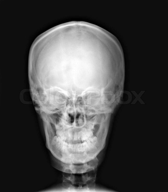 Detail of neck and head x-ray image, stock photo