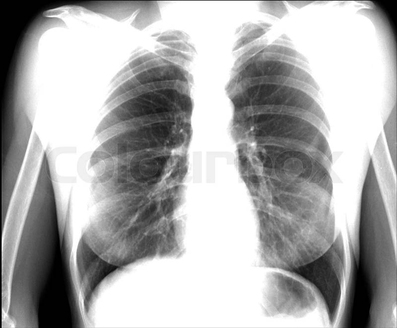A chest x-ray image for a medical diagnosis, stock photo