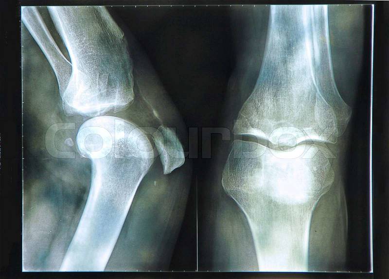 X-Ray image if the human knee , stock photo