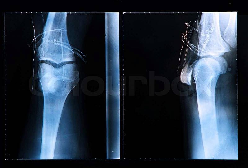 Knee X-ray after surgery for Anterior cruciate ligament injury, stock photo