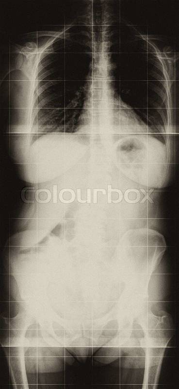 MRI Scan of Spine Magnetic resonance imaging frontal view, stock photo