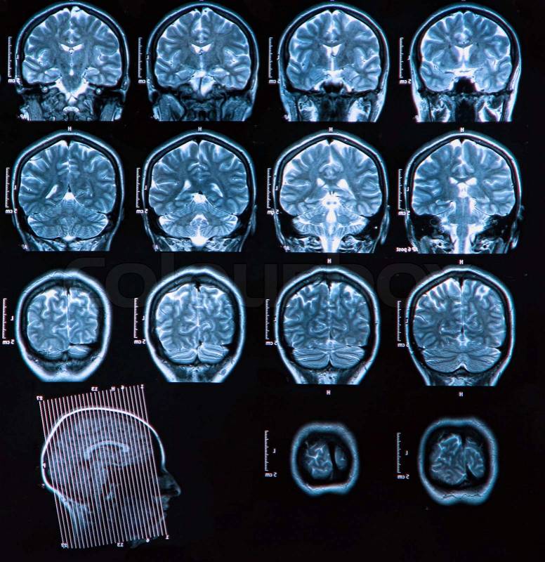 MRI scan of the human brain, stock photo