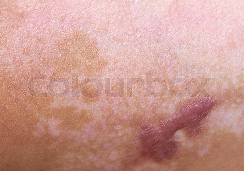 Scar from a burn on the skin, stock photo