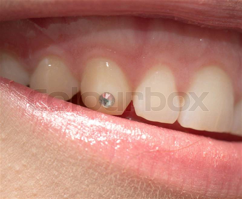 Jewel in the tooth, stock photo