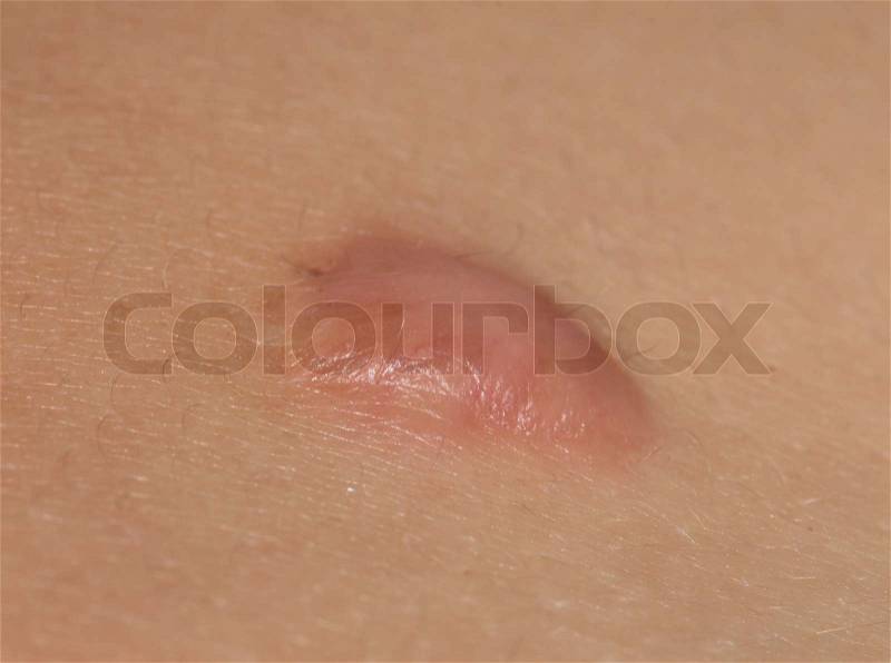 Scar from the removal of a mole. macro, stock photo