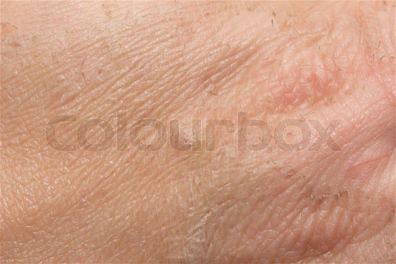 Traces of burns on the skin. macro, stock photo