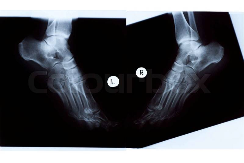 X-ray of the mature woman feet, left and right sides view, stock photo