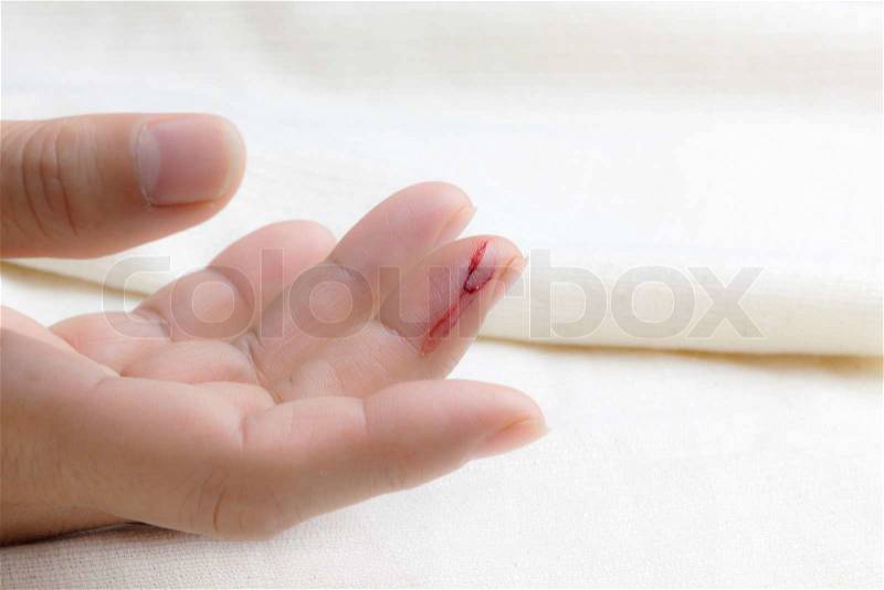 Injured finger with bleeding open cut, stock photo
