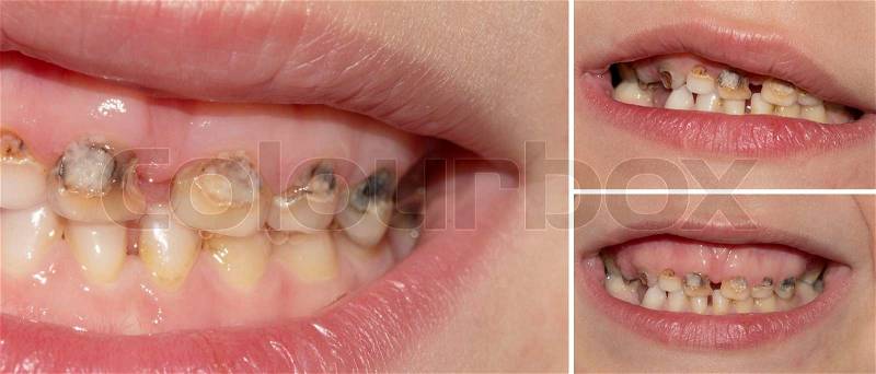 Dental medicine and healthcare - human patient open mouth showing caries teeth decay, stock photo