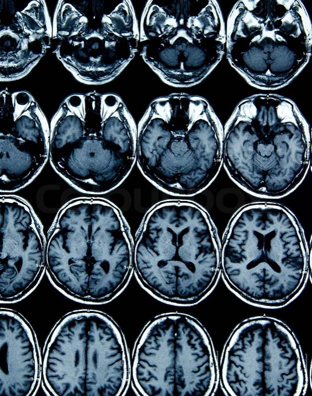 MRI scan image of brain for diagnosis, stock photo