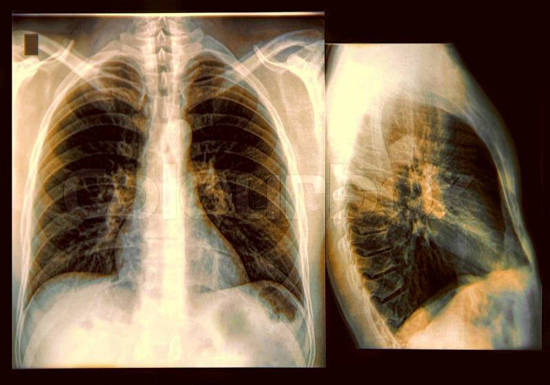 X-Ray image if the human chest, stock photo