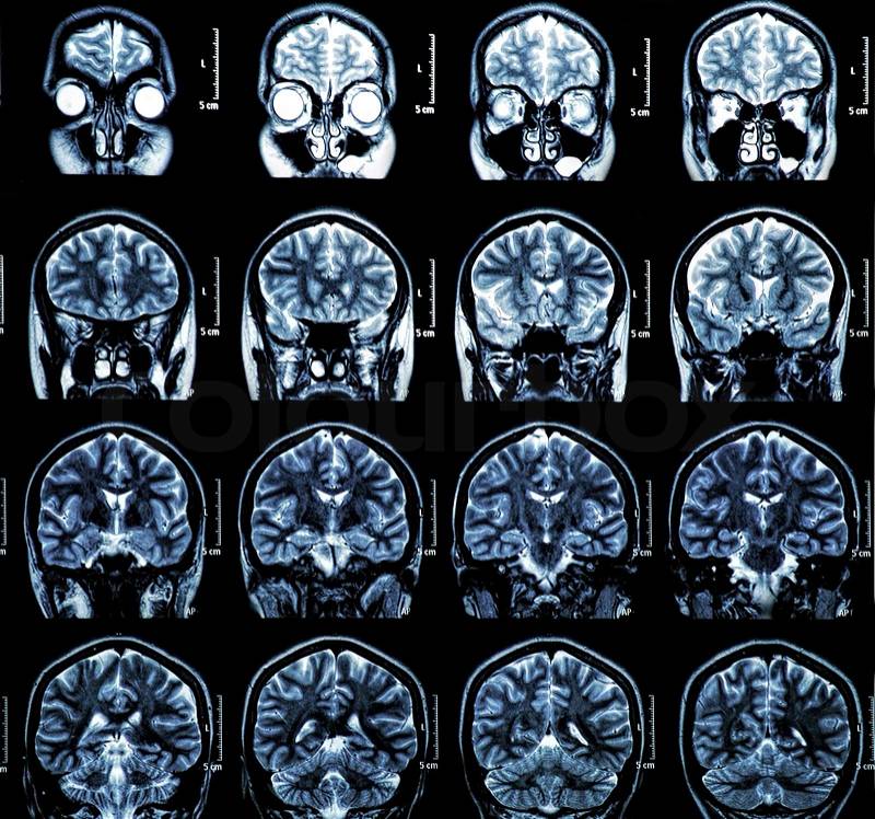 MRI scan of the human brain, stock photo