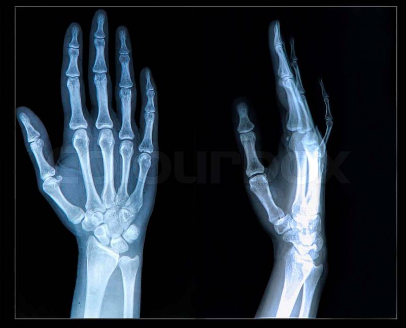 Xray of human Hand/ fingers, stock photo