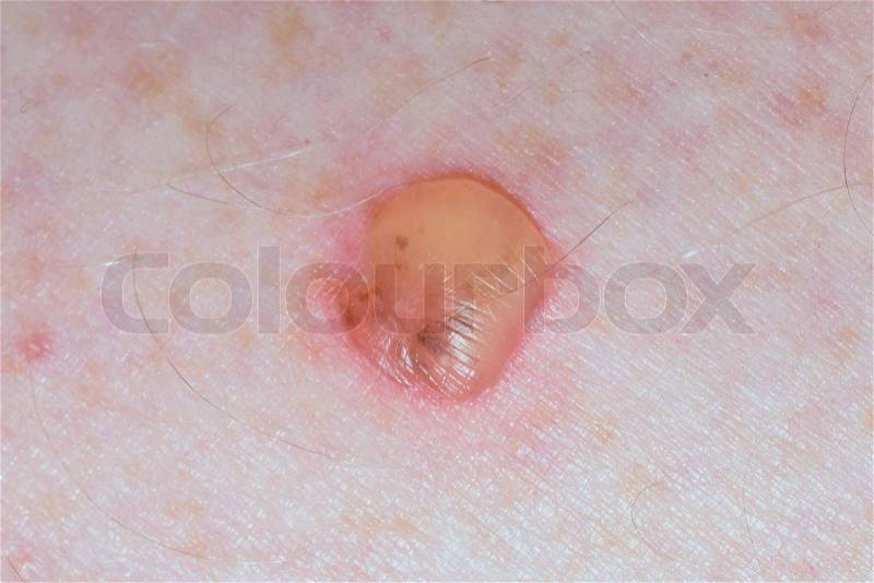 A blister wound on human caucasian skin, stock photo