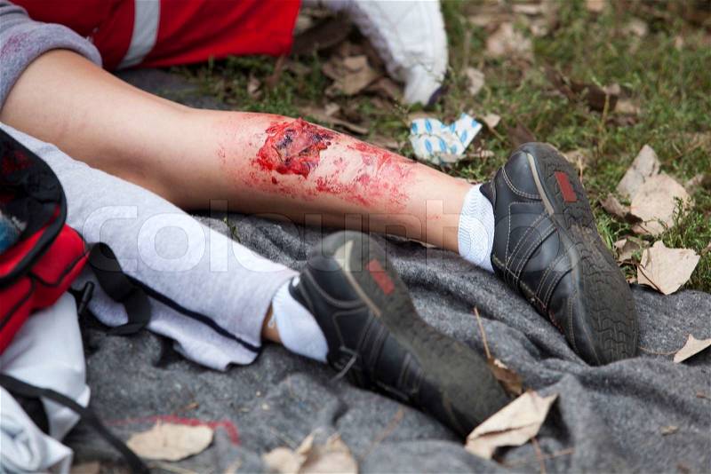 Serious injury on girl\'s leg, stock photo