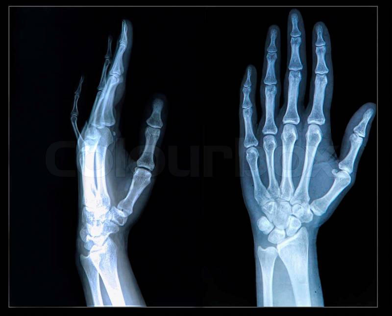 Xray of human Hand/ fingers, stock photo