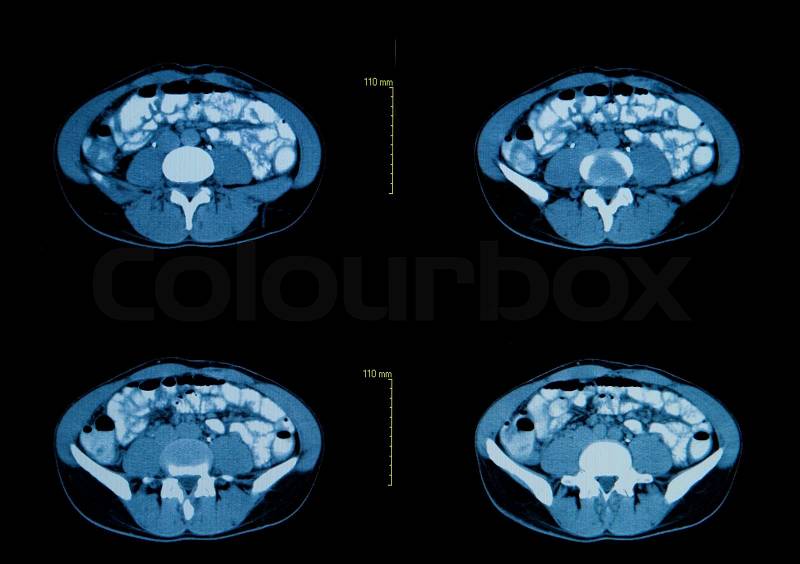 Computed tomography of the chest. Medical background, stock photo